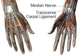 Carpal Tunnel