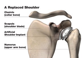 Replaced Shoulder
