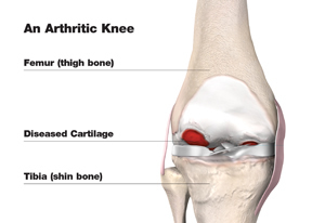 Arthritic Knee
