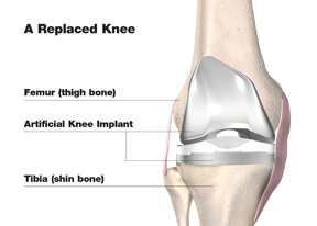 Knee Replacement